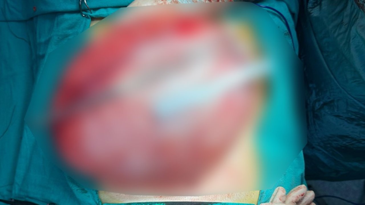 Kilo vermek için hastaneye giden çocuğun karnından 3,5 kiloluk kist çıktı